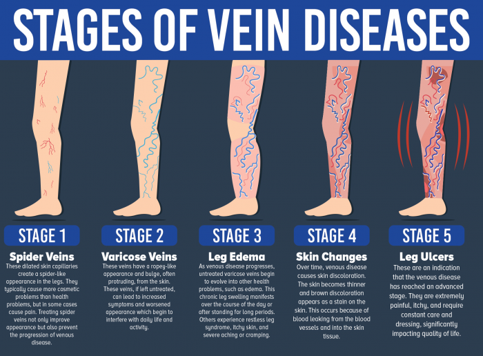 salem-interventional-radiology-free-vein-pad-screening