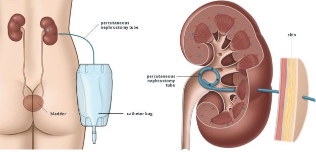 Percutaneous Nephrostomy Tube Placement